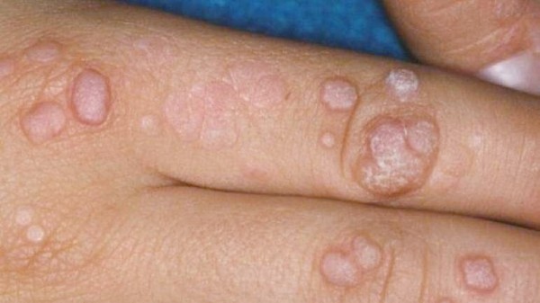 دراسة تحذر من أعراض خطيرة وجديدة لمرض جدري القرود 3